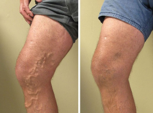 avant et après la chirurgie